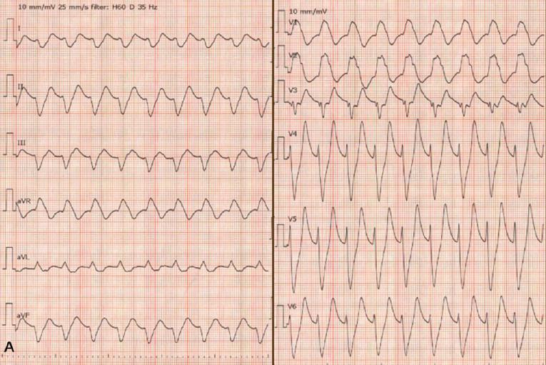 Second In A Series On Hyperkalemia What Are The Clinical Consequences